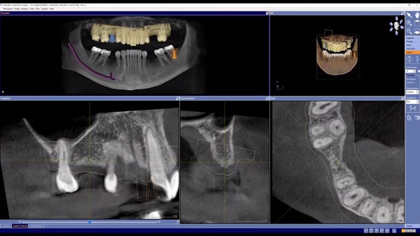 3D Implantatplanung Galileos