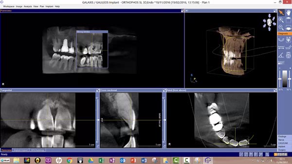 3D Implantatplanung Galileos