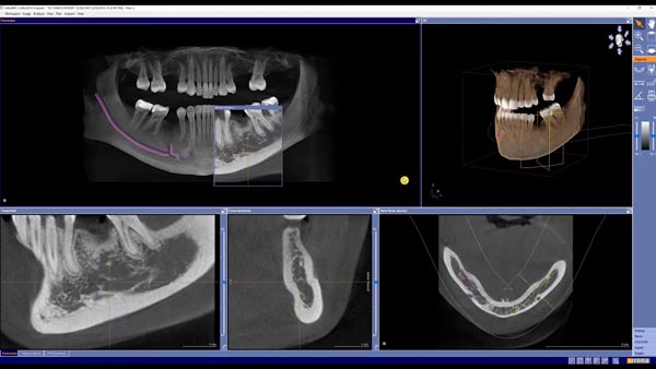 3D Implantatplanung Galileos