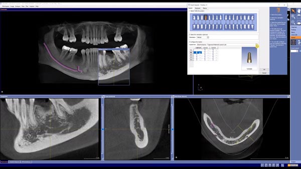 3D Implantatplanung Galileos