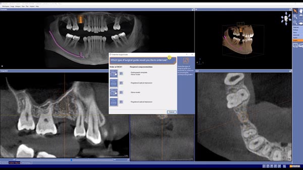 3D Implantatplanung Galileos
