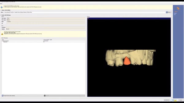 3D Implantatplanung Galileos