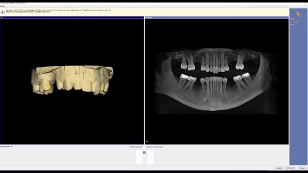 3D Implantatplanung Galileos