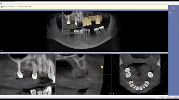 3D Implantatplanung Galileos